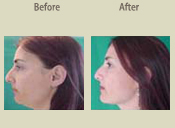 Before & After Photo