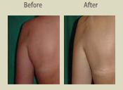 Before & After Photo